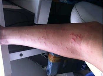 Hvordan skal urticaria håndteres?